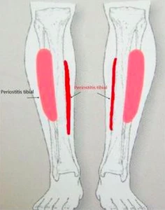 Source: https://fr.triatlonnoticias.com/articulos-fisioterapia/periostitis-tibial-mal-del-corredor/